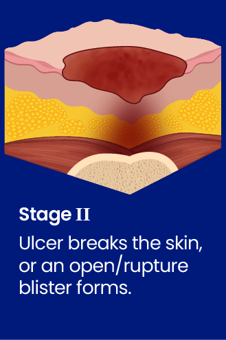 What are the Stages of Bedsores? Are they preventable? Treatable