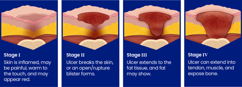 what-are-the-stages-of-bedsores-are-they-preventable-treatable