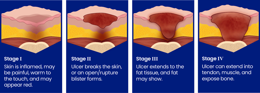 Bedsore Stages 1 2 3 4 illustration