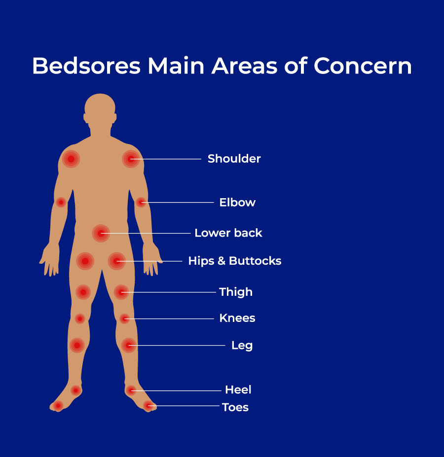 nursing home bedsore assistance